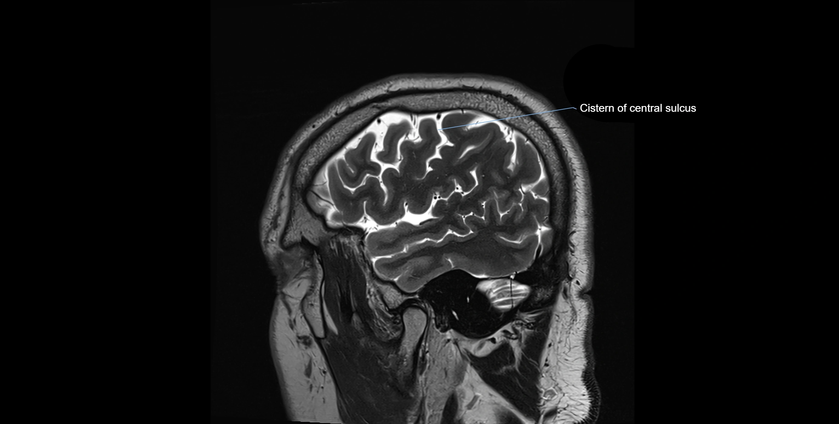 Brain cisterns  and ventricles sagittal anatomy 3T MRI image-img-00001-00007.webp